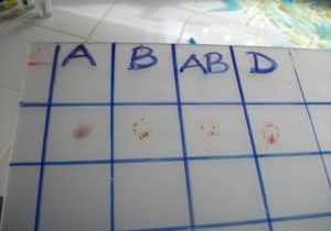 Dabou Clinical Lab: Determining my own blood type<br>via blood antibody-antigen agglutination tests